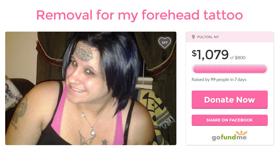 forehead tattoo removal